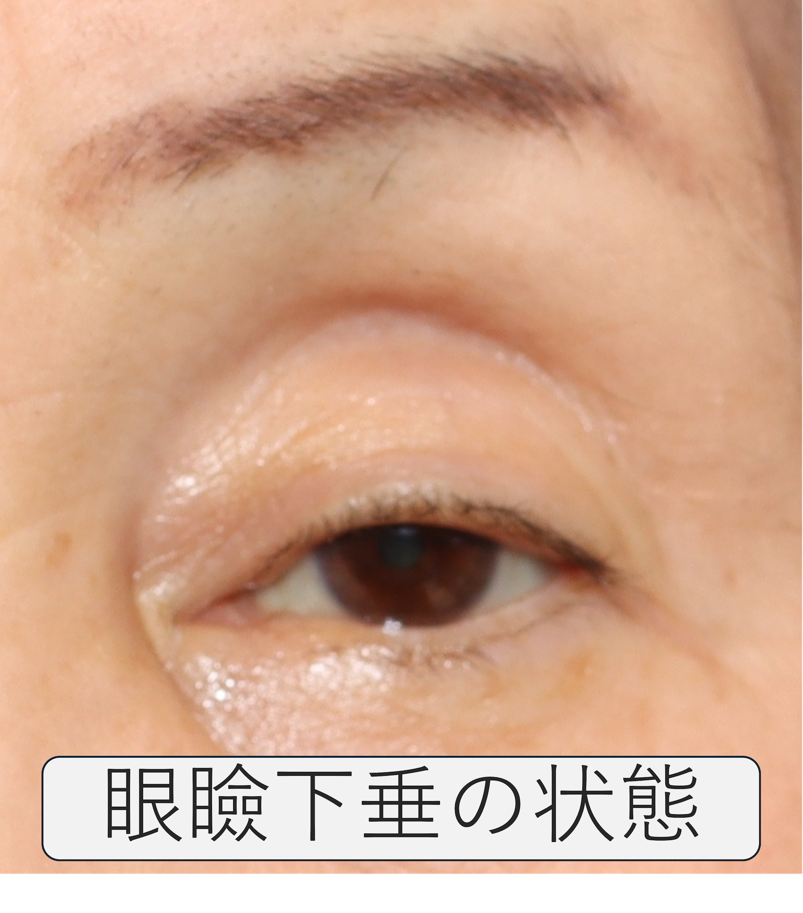 まぶたの手術 | 掛川花鳥園前眼科